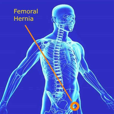 hernia femoral